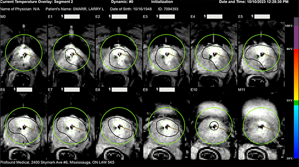 Larry Smarr’s Prostate Cancer Early Detection and Focal Therapy – Focus on Post-Therapy Time Series